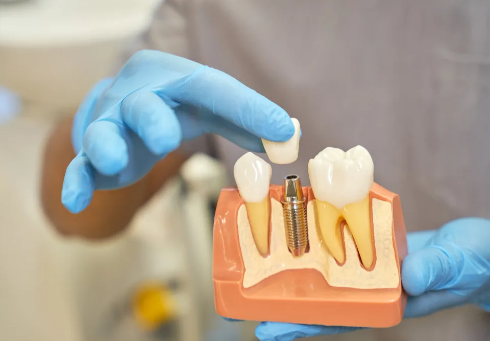 dental implants